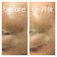 美肌再生スペシャルコース　1回