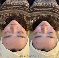 『お勧めの顔脱毛(シェービング‪付き)』スキンケアが浸透し肌トラブル改善🫧⟡.*美肌効果◎（45分）