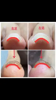 フット巻き爪・陥入爪対応(両親指) 90分