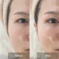 小顔フェイシャルエステ