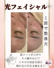 【新規】美肌光ケア