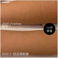 【メンズ脱毛】　両ウデ　￥2200