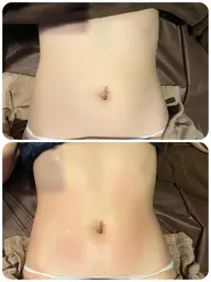 フォースカッター痩身エステお好きなパーツ１箇所6600円が初回のみお試し3300円✨