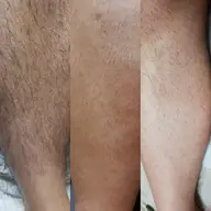 【メンズ脱毛】ひざ下脱毛5000円