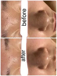 ハイドロスプラッシュ！出来たての水素水で毛穴洗浄！