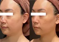 【エステ版】糸リフト