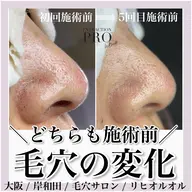 【新規】《美肌デコルテコース》プロの毛穴洗浄でお肌すっきり✨️更に、デコルテ・肩・首・背中まですっきりほぐします🌿