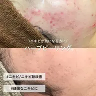 【ニキビ・ニキビ跡に】ハーブピーリング🌿