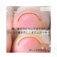 平日限定♪痛い巻き爪ケアーモニター募集♪
