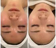 ✨美肌フォト✨顔全体🎀