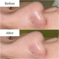 【平日限定】毛穴洗浄ハイドロスプラッシュ※男女OK！