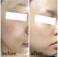 ヒト幹細胞配合ハーブピーリング🌿‬