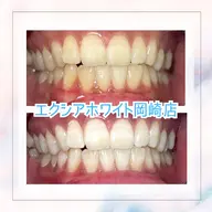 【minimo限定】セルフホワイトニング(3照射)¥2,000円