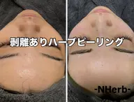 【剥けるハーブピーリング】ダウンタイムあります