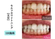 【ピュアホワイトニング】白い歯で自信溢れる笑顔に♪お子様にも◎ 《初回限定💫特別価格》