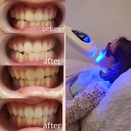 スペシャルSET🤩まつげパーマ【カール、パリ何でもOK】&ホワイトニング🦷