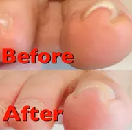 巻き爪矯正B\Sブレイスクイック、１０本ケア付き、（片方）