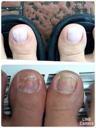 トラブルネイル補正（親指２本）