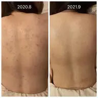 【💚背中を綺麗にしたい方💚】背中ハーブピーリングでツルツル🌿😭ニキビ・ニキビ跡・ザラつき・色素沈着を改善❣️