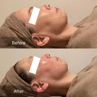 エレクトロポレーション💎口コミ🈹40・50代〜毛穴、たるみ、乾燥、目元口元の小ジワに効果的💫