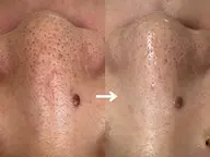 【ドバッと毛穴汚れ★小顔ケア付】角栓・黒ずみ・徹底毛穴洗浄!!