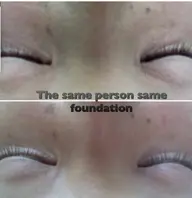 VC、低分子ヒアルロン酸美容液導入