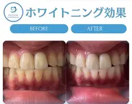 4月限定初回体験¥1580セルフホワイトニング63%OFF（大阪梅田最安値）先着6名20分照射