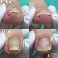 【巻き爪補正】1爪の巻き爪補正✨痛い💥巻き爪は早めのケアが大切💡形が気になる方もご相談ください💁🏻♀️
