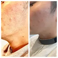 メンズひげ脱毛