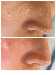 【毛穴洗浄】ピーリング角栓黒ずみ除去！ハイドラ＆美容液導入エレクトロポレーション60分💎✨￥22000→