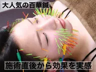 【100本美容鍼+小顔矯正】鍼でリンパの流れや血行を促進しむくみ・たるみ改善