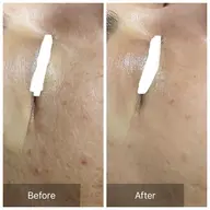 【特に目元が気になる方】ハーブピーリング🌿.∘