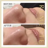 【✨口コミ記載の方体験半額！✨】★期間限定★毛穴の汚れを一掃✨ハイドラフェイシャル（毛穴洗浄）‼️ニキビや黒ずみに効果