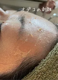 グリーンピール 3daysホームケア3日で最も結果の出る5daysに近い効果を出します。金土日で出来ます。