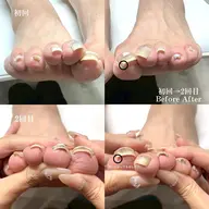【片親指】🌸巻き爪矯正
