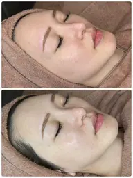 【美白・タイトニング】ミルクライト🐰🍼 症例写真の撮影可能な方📷