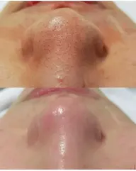 【黒ずみ毛穴/ニキビケア/角質除去】毛穴掃除コース➕医療パック