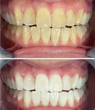 【歯科提携ホワイトニング】！30分4980円で歯科ホワイトニングを体験！