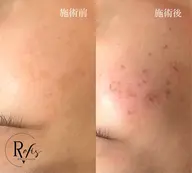 【シミ取り放題‼️✨️】肌に負担がかからず、痛みゼロ!気になるシミをどんどん排出🔥若見え肌🤍腕もok🎶