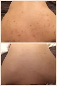 限定《ニキビ撲滅❣️剥離なし背中ピーリング&鎮静パック》ブライダルにも⭕️