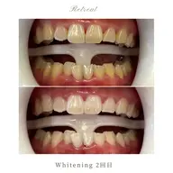 【白さを実感したい方】スタンダード2回コース  1回/8,800