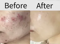 【効果No1🏅】本気の肌結果！最強コース　どんな肌悩みにも💆‍♀️ 生コラーゲンパック付