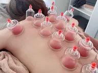 【むくみ撃退‼️】足と背中のスッキリカッピング（吸玉）⭐️