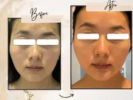 【予告】小顔ケア撮影モデル募集(目隠しB&Aの写真)【4月から募集開始】