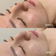 口コミ投稿いただける方限定！ニキビケア特化オプション付ハーブピーリング(VCF.エンザイムオプション¥7700付)