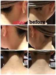 お顔✩襟足✩シェービング