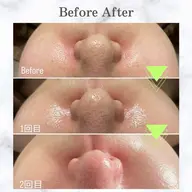 韓国式美肌毛穴洗浄🇰🇷✨【鼻のみ】