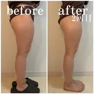 【脚やせコース✨】２つのマシーンでお悩みにしっかりアプローチ🌻むくみ、ハリ、セルライトが同時にケアできるコースです！