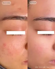 人気No. 1メニュー：パール肌トリートメント（マシン付き）