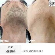 メンズ脱毛【ヒゲ】